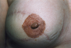Breast Reconstruction 6c